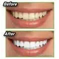 Miracle Teeth Whitener | مبيض الأسنان المعجزة